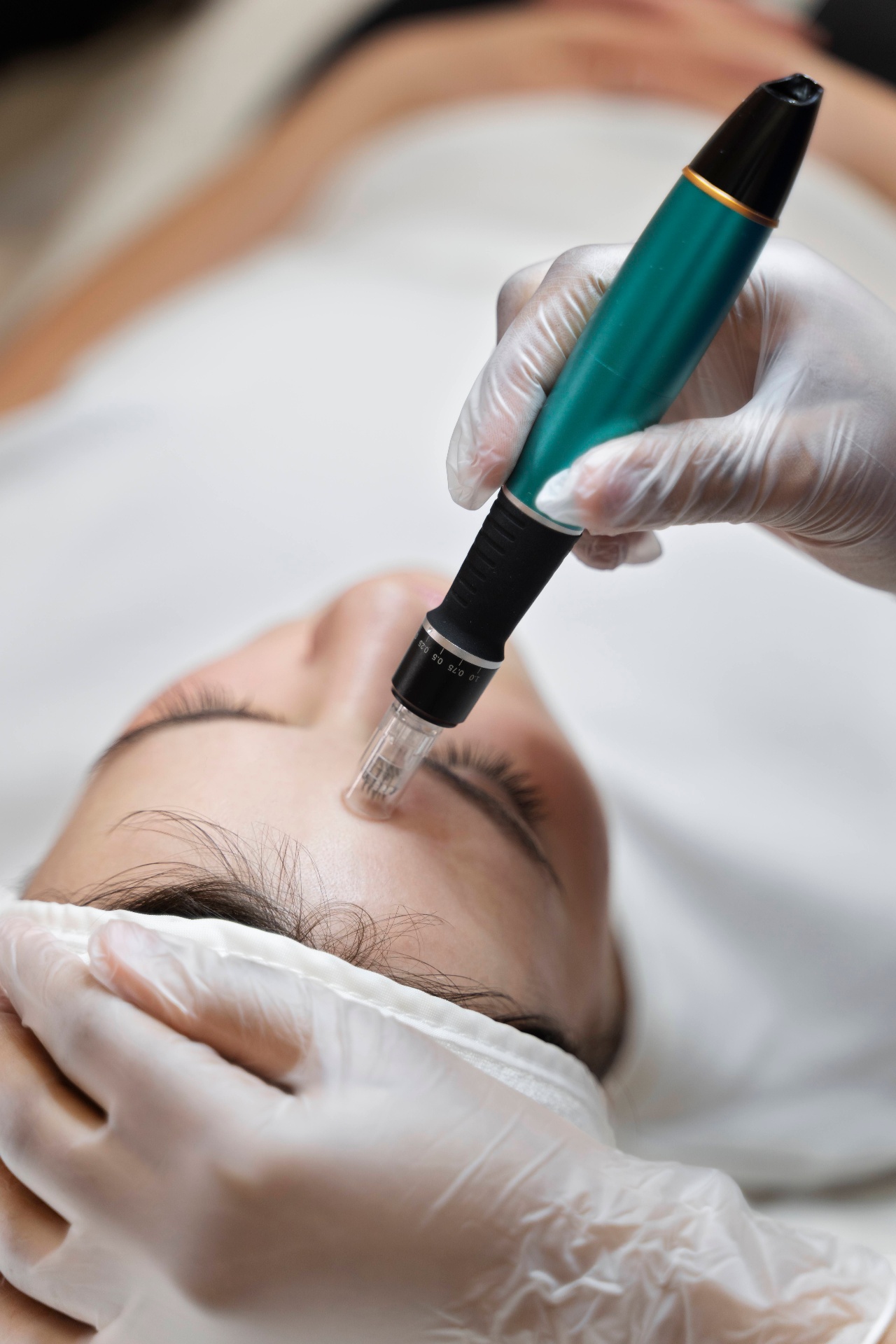 Microneedling